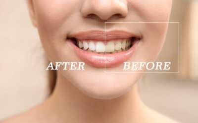 7 Questions to Ask Before Choosing a Cosmetic Dentist in Lexington