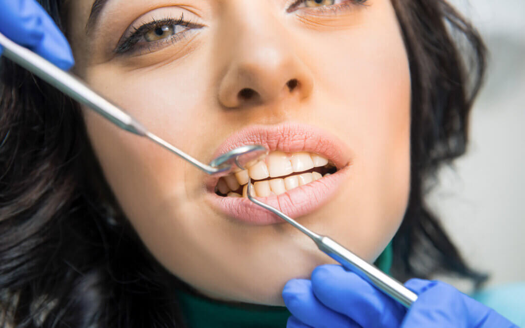 What Are Your Options for Chipped Tooth Treatment?