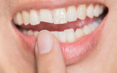 Can A Lexington Cosmetic Dentist Permanently Fix Worn or Chipped Teeth?