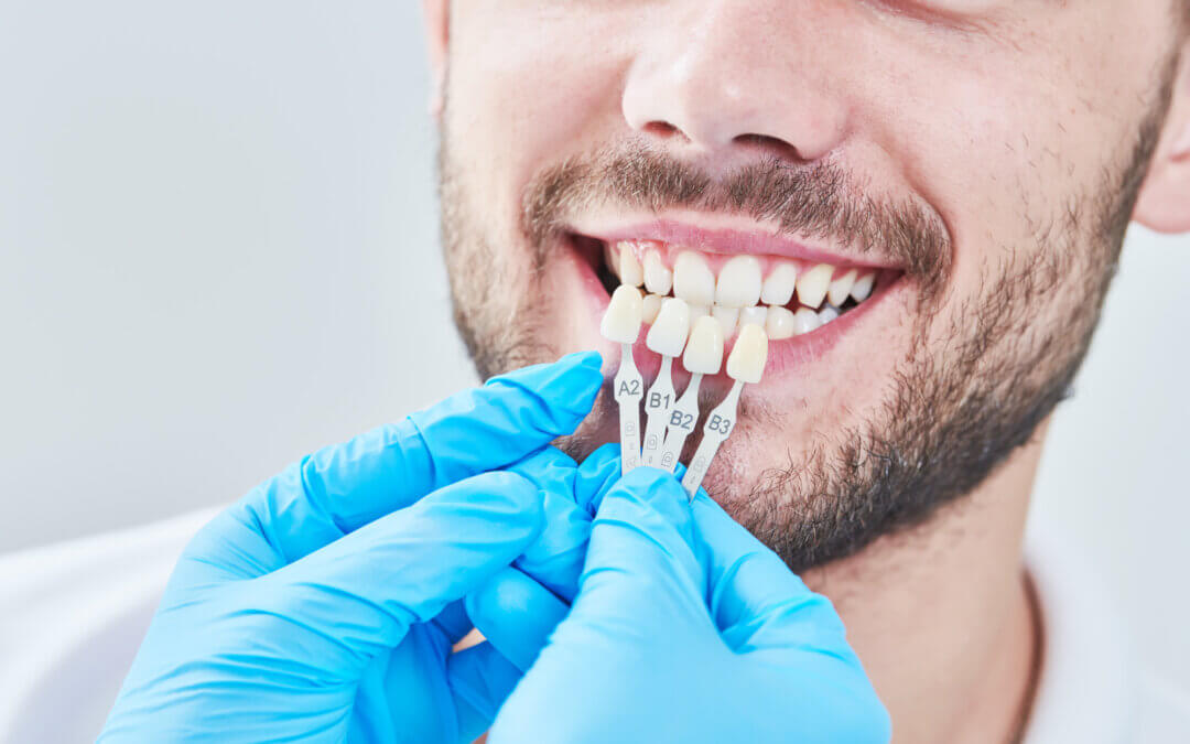 Top 10 Questions About Veneers to Ask Your Dentist