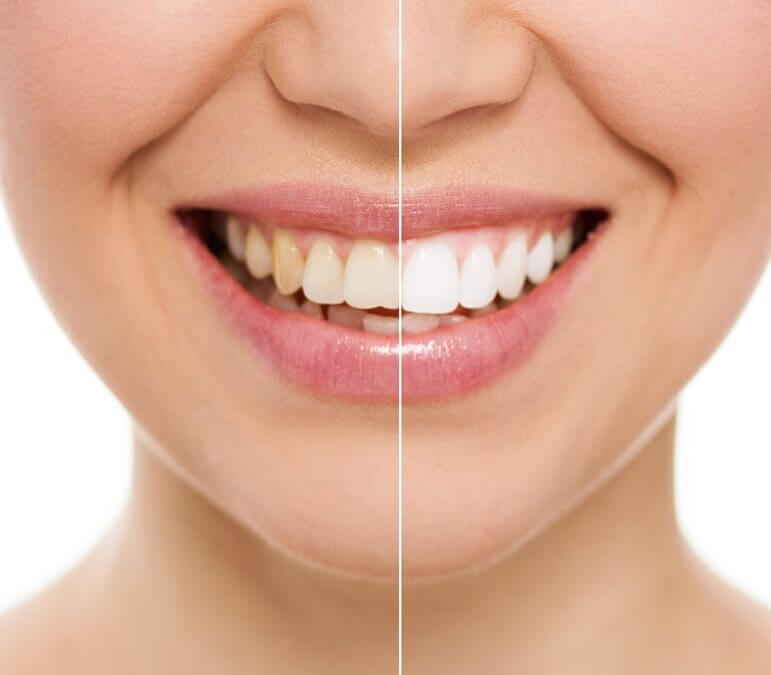 woman's smile with half of it whitened